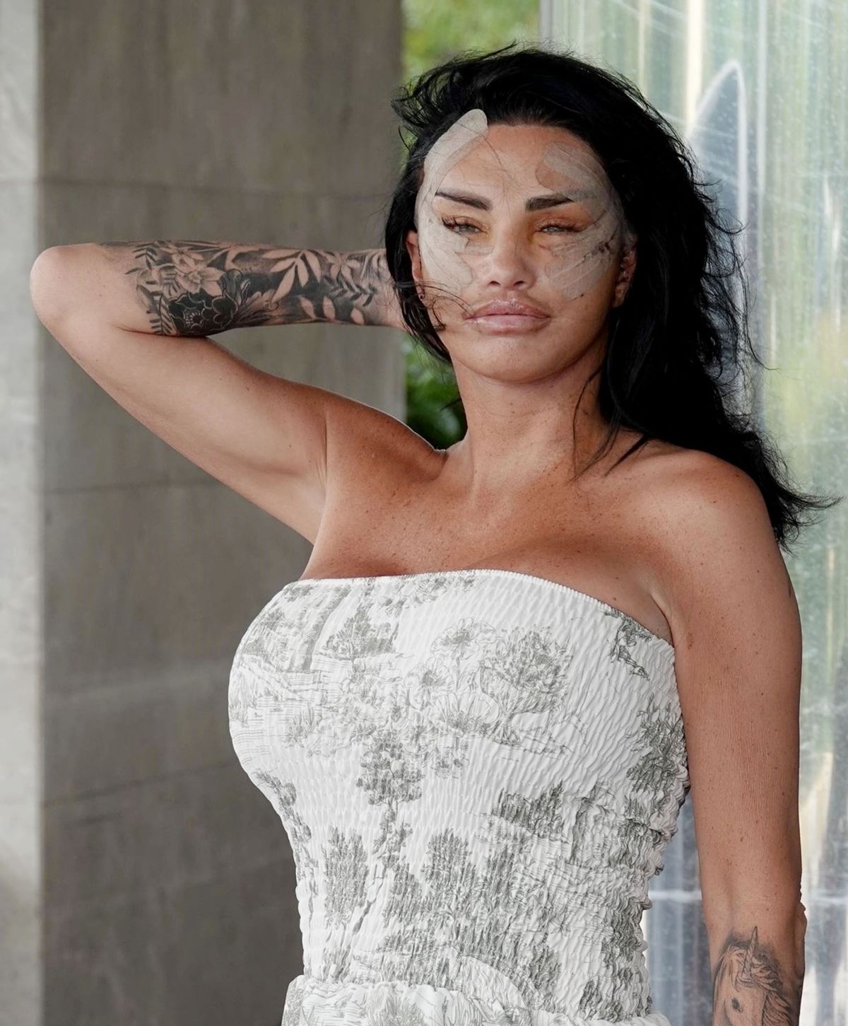 Katie Price Heavily Bruised Face During Turkish Getaway